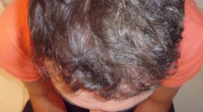 Hajátültetés – Hajbeültetés – Hajtranszplantáció Férfiak Esetében
